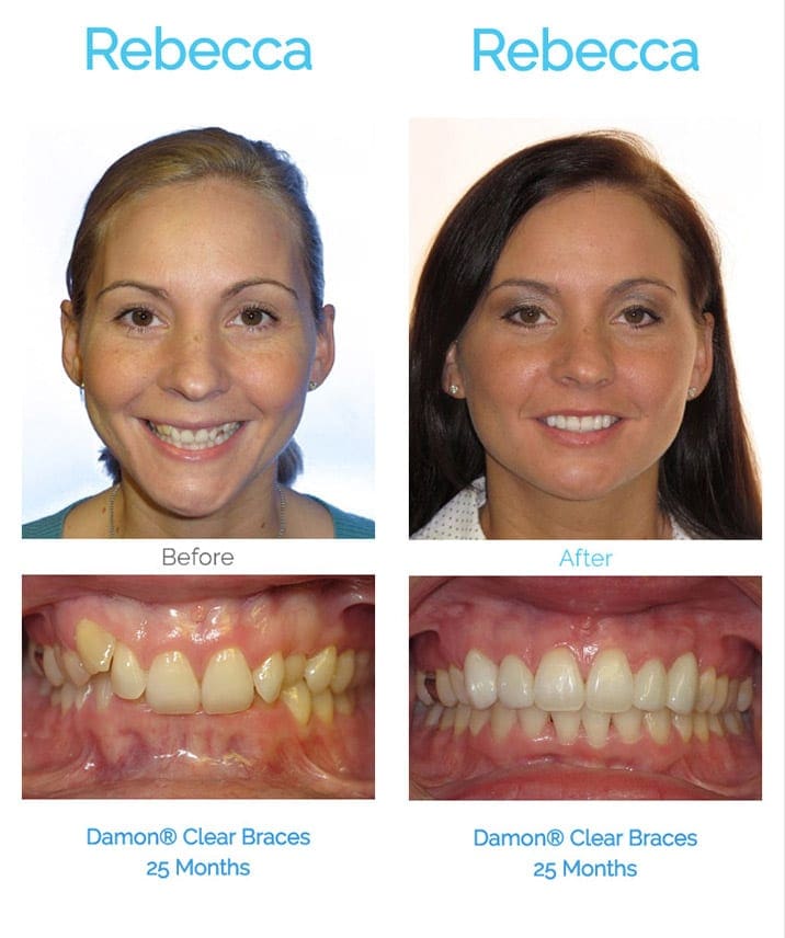 before and after braces adults