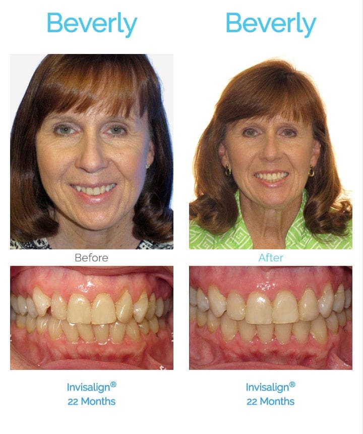 before and after braces adults