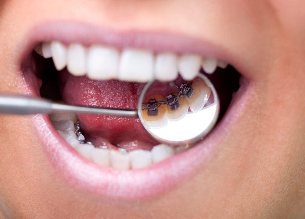 Dental mirror showing lingual braces Lingual (behind the teeth) braces