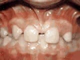 Missing lateral incisors before