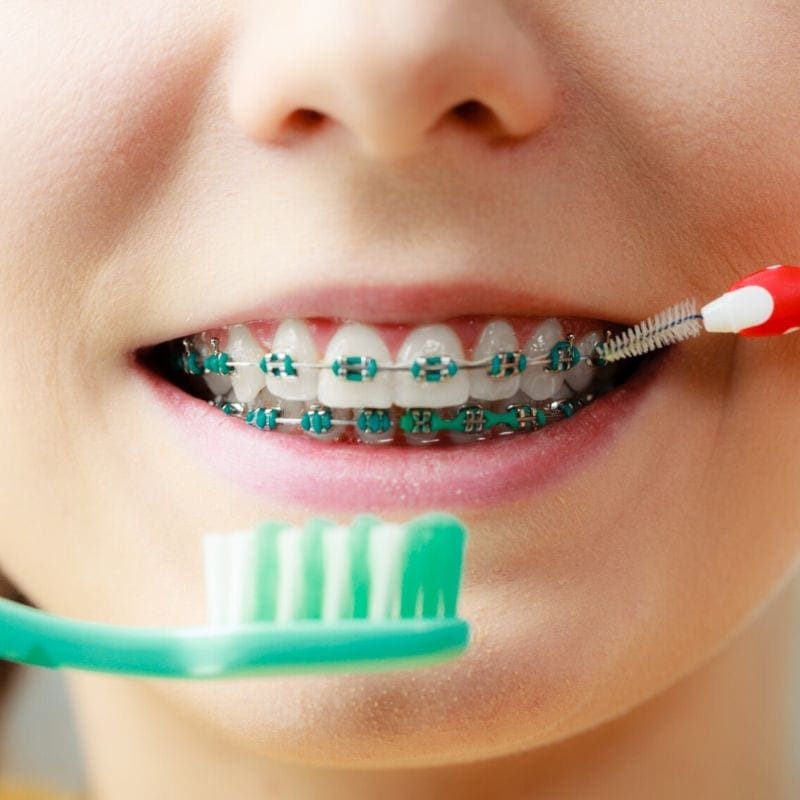 The Importance of Dental Hygiene with Braces