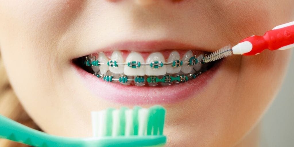 Brushing and Flossing With Braces