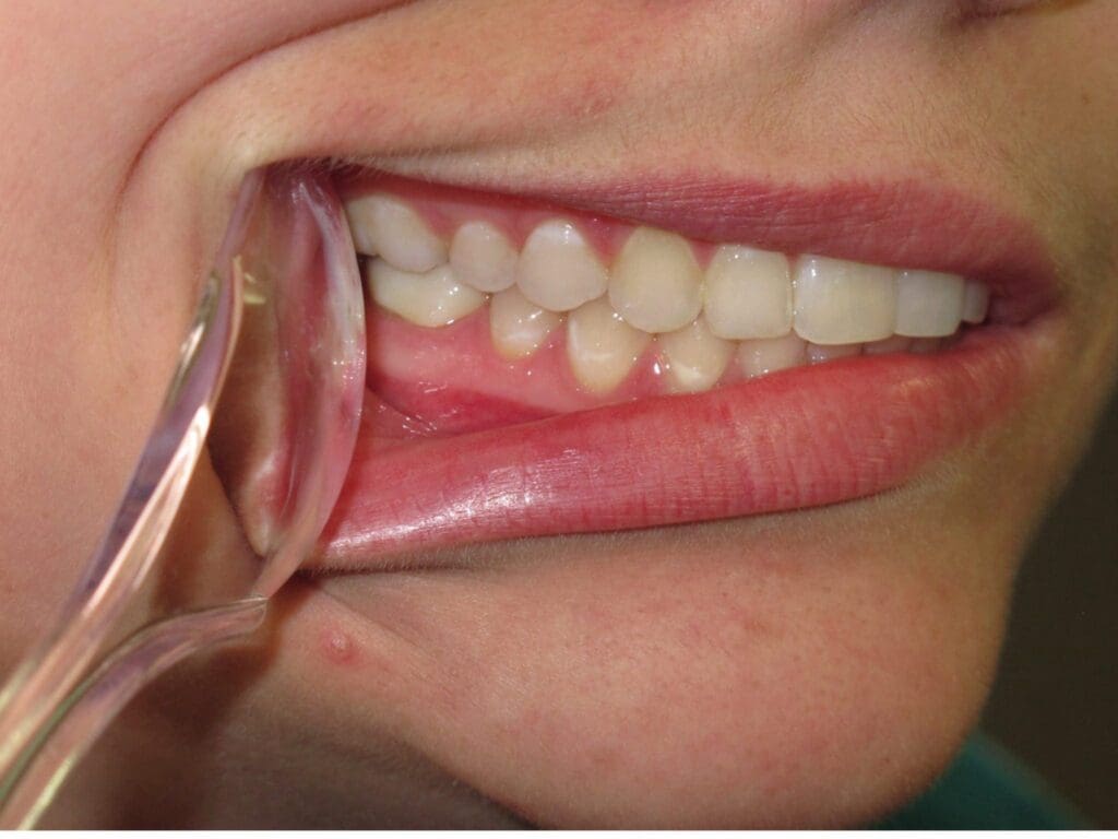 Frontal Intraoral Photo Frontal Intraoral Photo