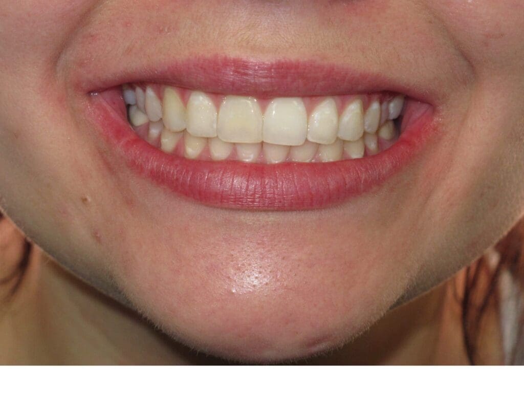 Left Intraoral Photo Left Intraoral Photo