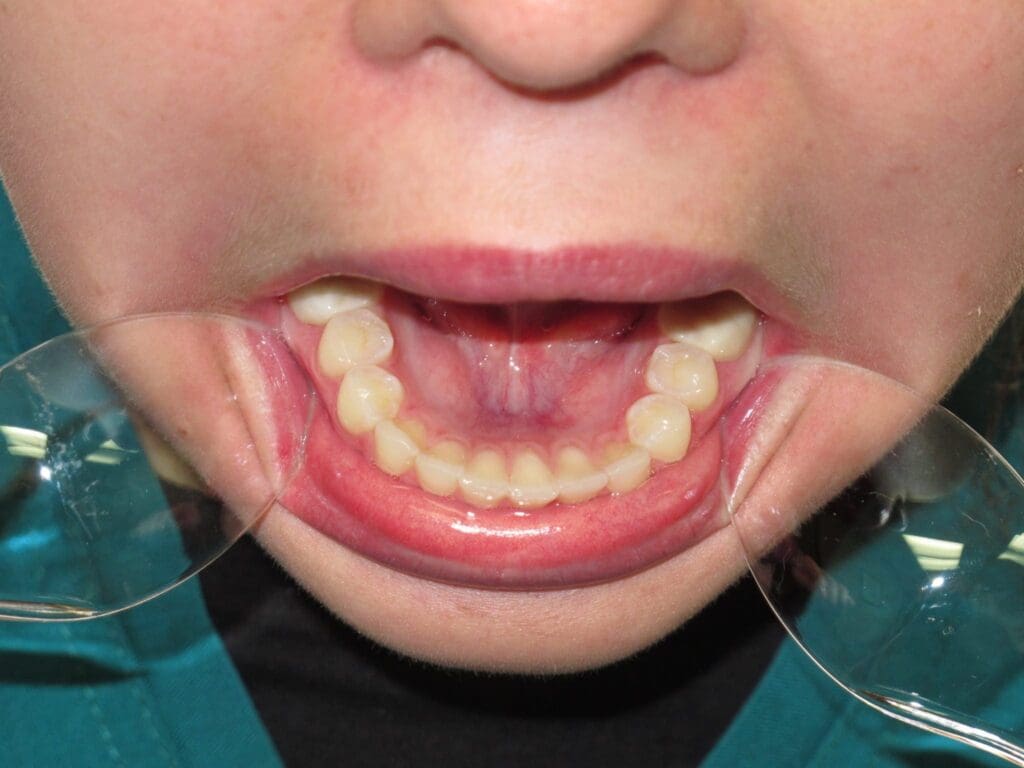 Occlusal Photo of Mandibular Dentition Occlusal Photo of Mandibular Dentition