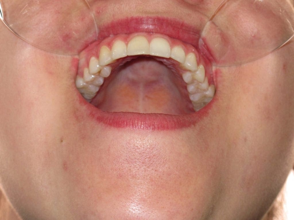 Occlusal Photo of Maxillary Dentition
