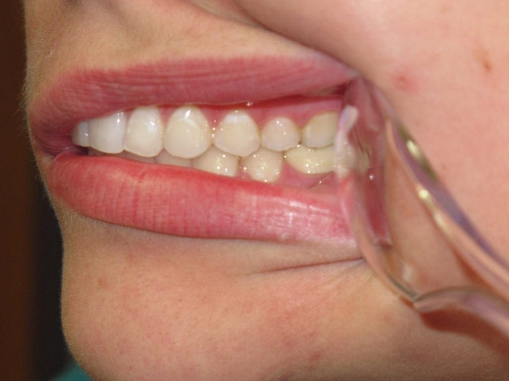 Right Intraoral Photo
