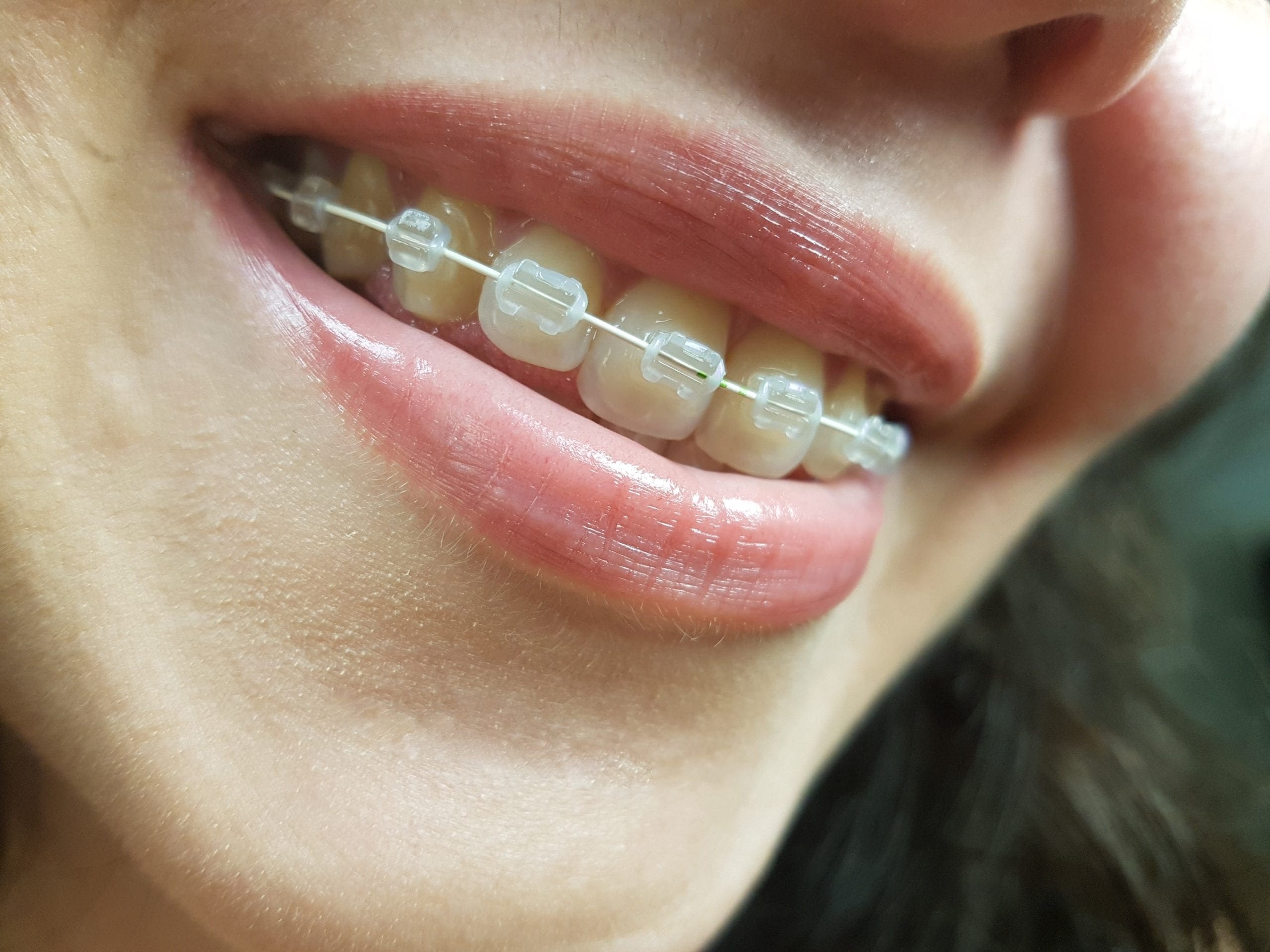 How much do braces cost?