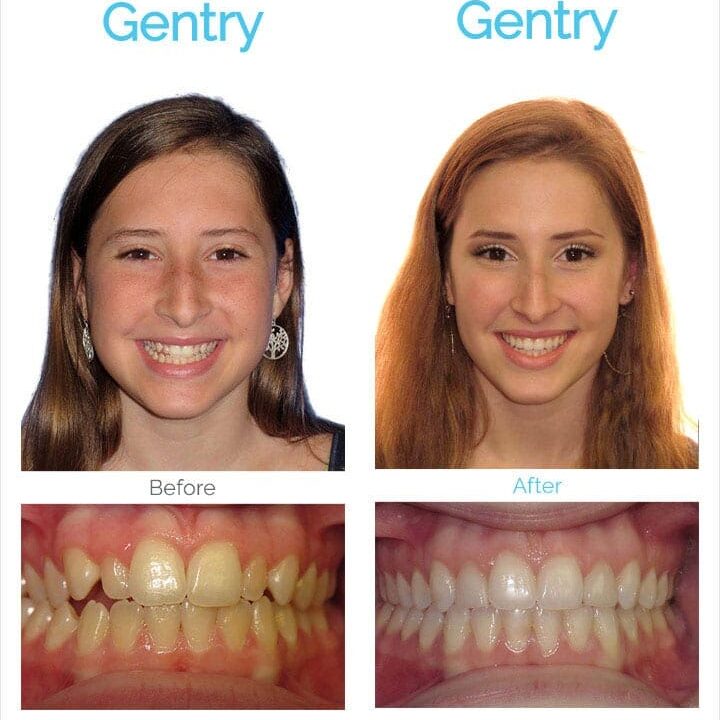 Before and after braces - Asheville NC teen patient Gentry - Roeder Orthodontics