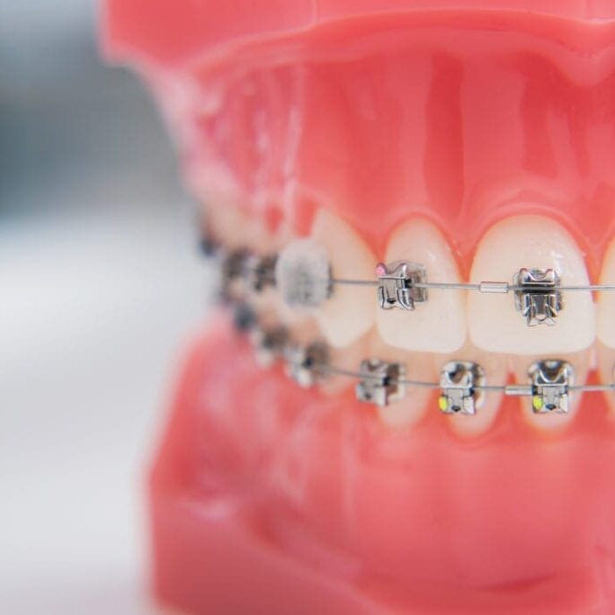 Metal braces on human jaw model